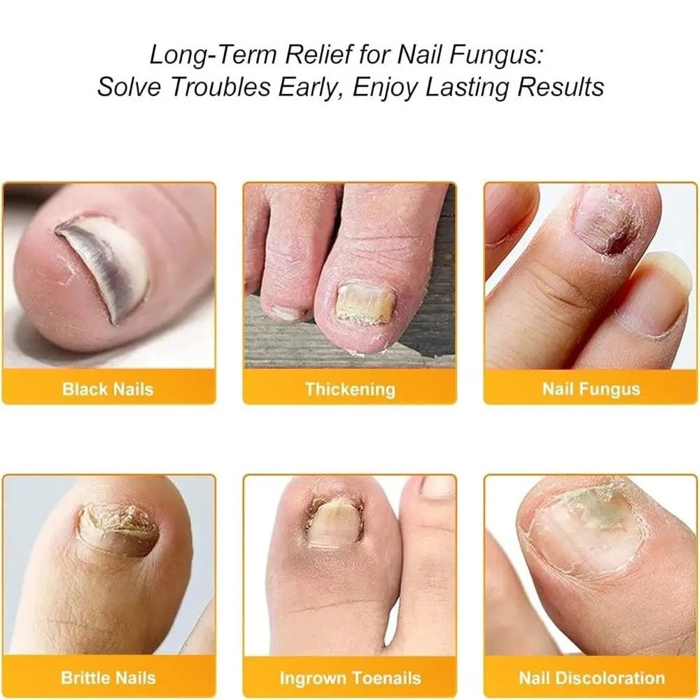 FungalPatch - Antybakteryjna Plaster na Grzybicę i Pielęgnacja Paznokci